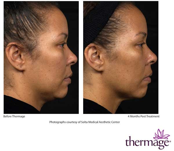 Before and After Thermage face treatment