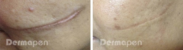 Before and after Dermapen on cut scar