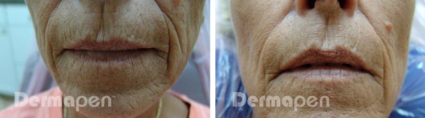 Before and after Dermapen on a womans lips