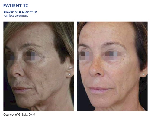 Aliaxin SR and EV Before and After Full Face