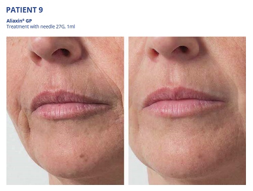 Aliaxin GP Before and After Mouth Lines