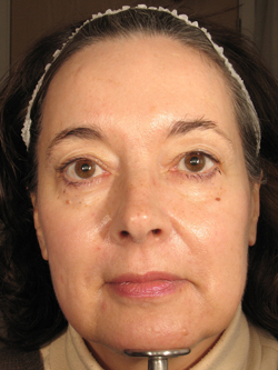 After Treatment with Sculptra