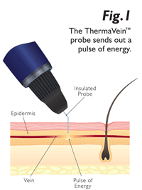 How the Thermavein works 