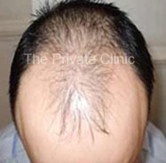 Male pattern Baldness