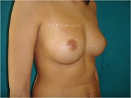breast augmentation with fat transfer - side view