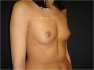 breasts before fat transfer - side view