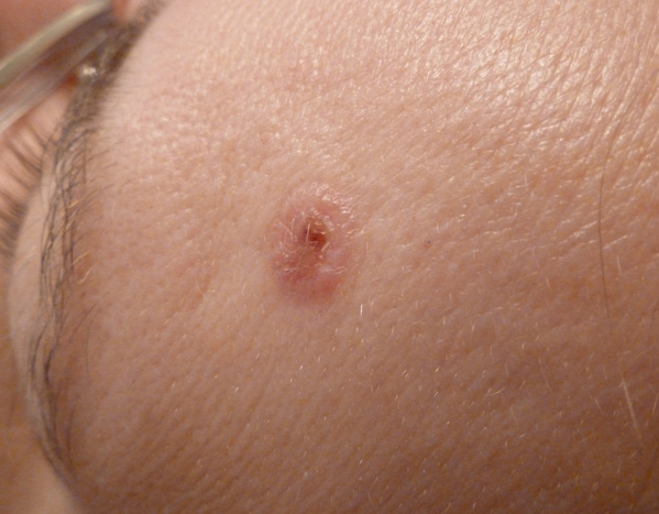Hairy mole one month after Advanced Electrolysis Treatment