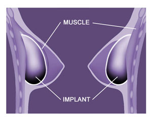 Breast Implant Positioning