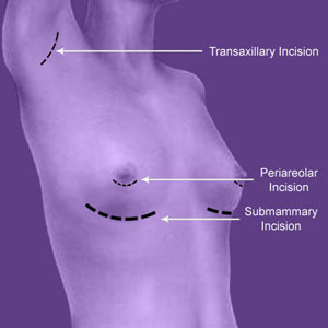 Breast Implant Entry Points