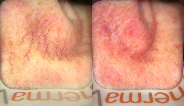 Thermavein treatment of thread veins on the nose