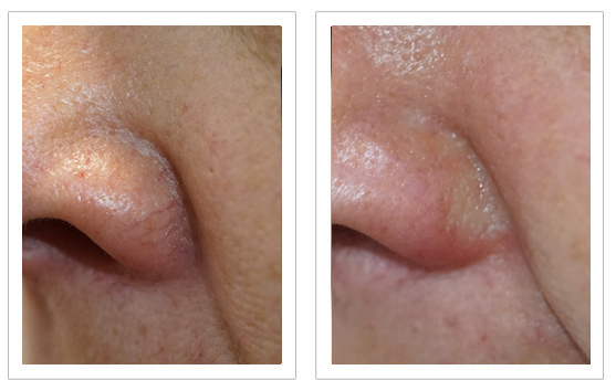 Before and after Thermavein treatment on nose