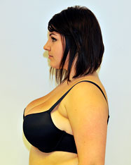 Female after liposuction breast reduction - Side View