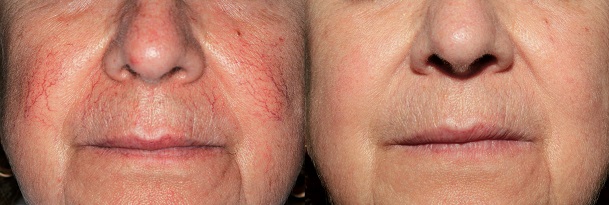 Remove of thread veins on the cheek with Thermavein