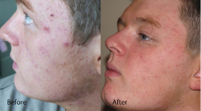 Thye results of before and after on a male with Acne