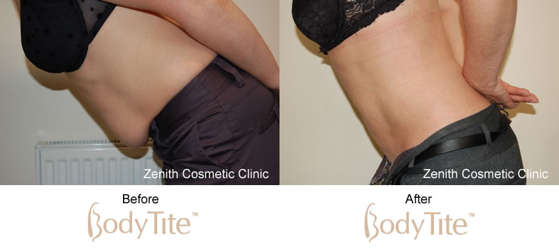 BodyTite before and after results abdomen
