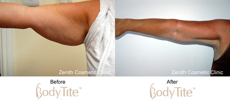 BodyTite before and after upper arms
