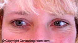 Patient smiling 7 days following Botox® injections to her right eye only