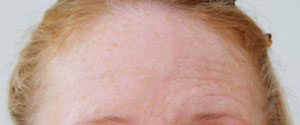 Female forehead before botulinum toxin treatment.