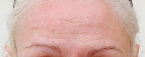 Female forehead before botulinum toxin treatment.