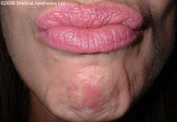 Popply chin before Botox treatment