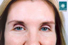 Patient showing a significant improvement in forehead lines 10 days after treatment.