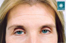 46 year old female with forehead lines before treatment with Botox® injections
