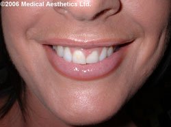 Gummy smile after Botox treatment
