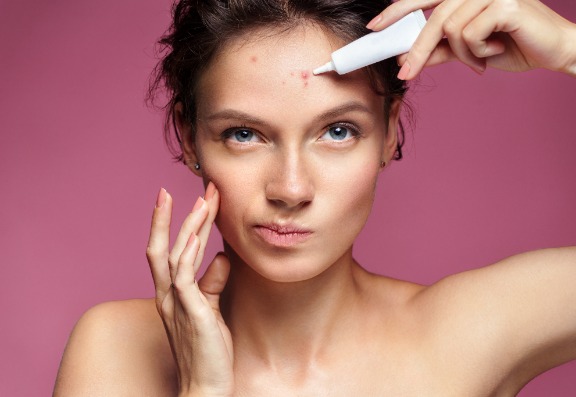 What Acne Treatments can I try When Pregnant?