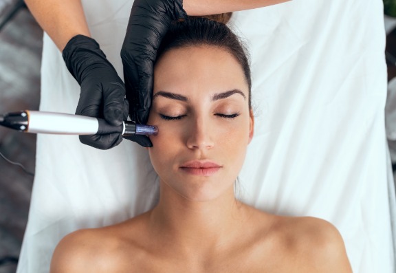 SkinPen treatment