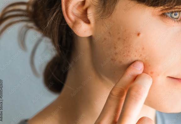 What Causes Adult Acne?