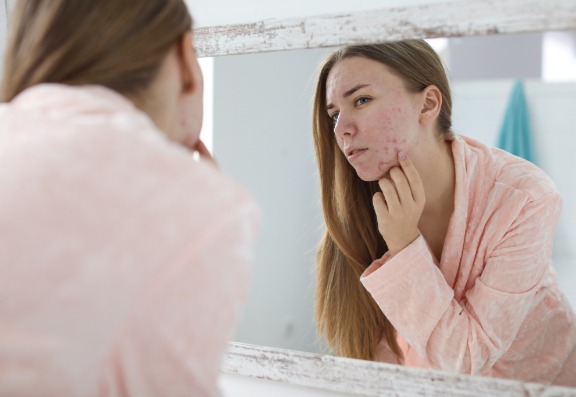 Only Teenagers Get Acne
