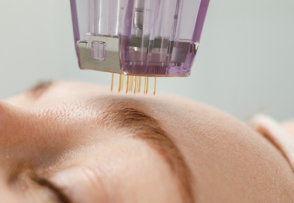 Understanding Microneedling and Collagen Induction