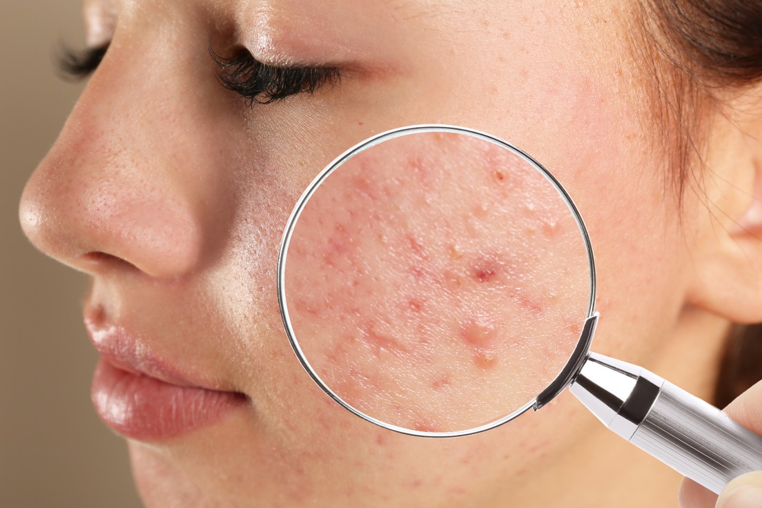Acne 2026 Acne 2026