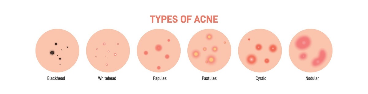 Acne banner Acne banner