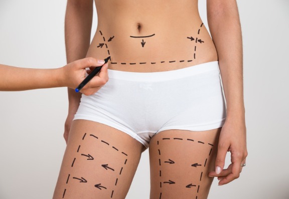The importance of addressing diet with liposuction patients