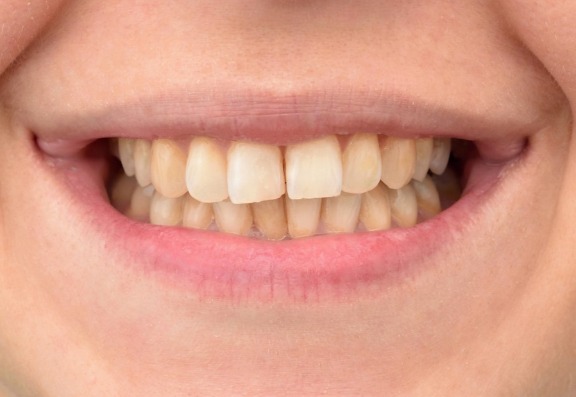 Is teeth whitening safe