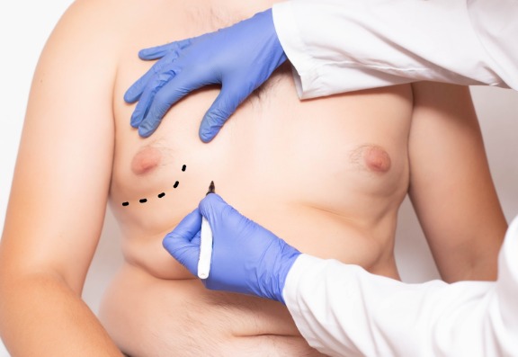 What does a liposuction procedure involve?