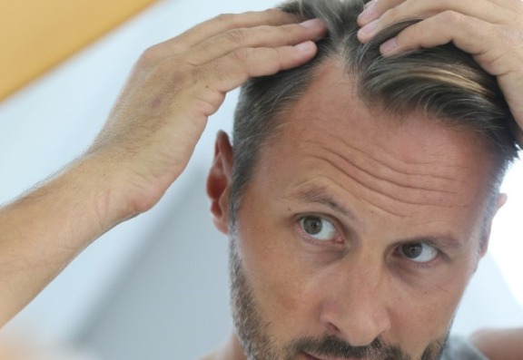 Common causes of hair loss in men