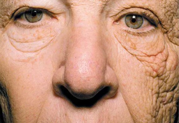 Image of a truck driver with severe skin damage
