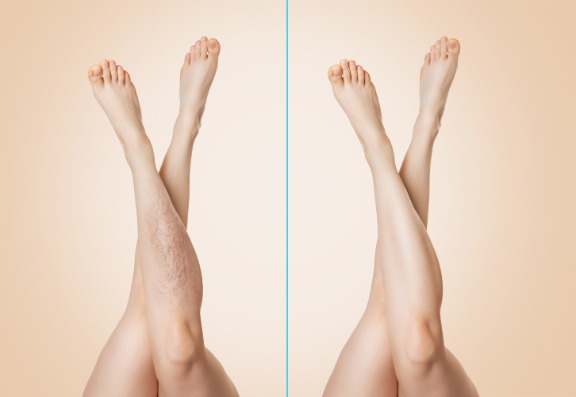 Choose Sclerotherapy For Spider Veins  