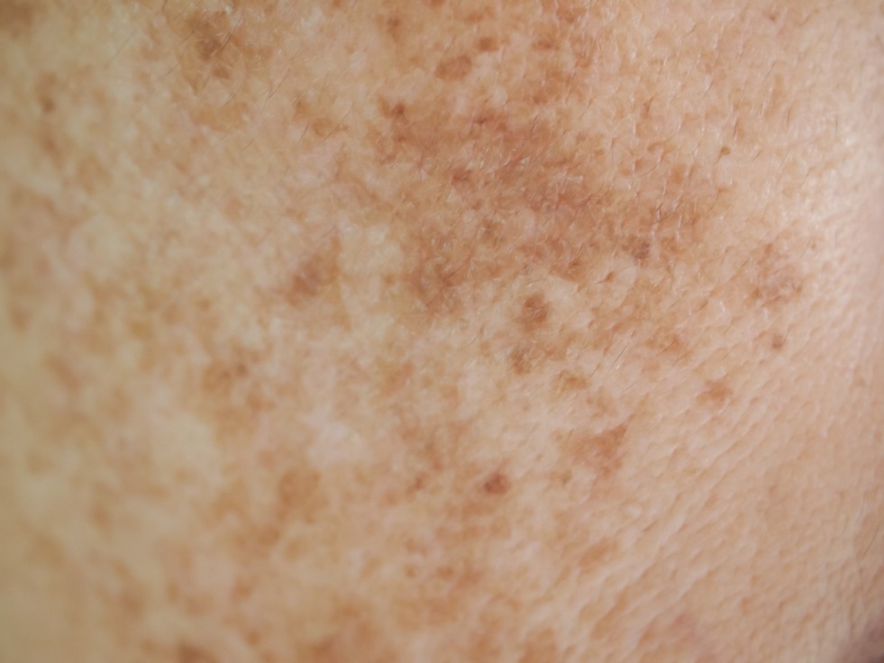 Pigmentation treatment