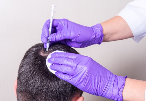 Men’s hair loss treatments