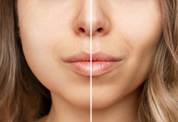 How effective is Buccal Fat Removal treatment