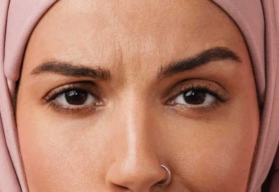 What Are Frown Lines?