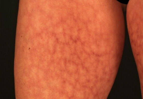 What causes toasted Skin Syndrome?