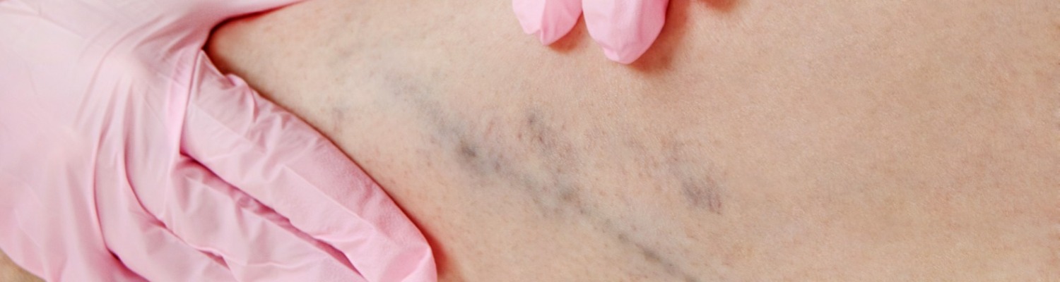 10 Things You Didn’t Know About Varicose Veins