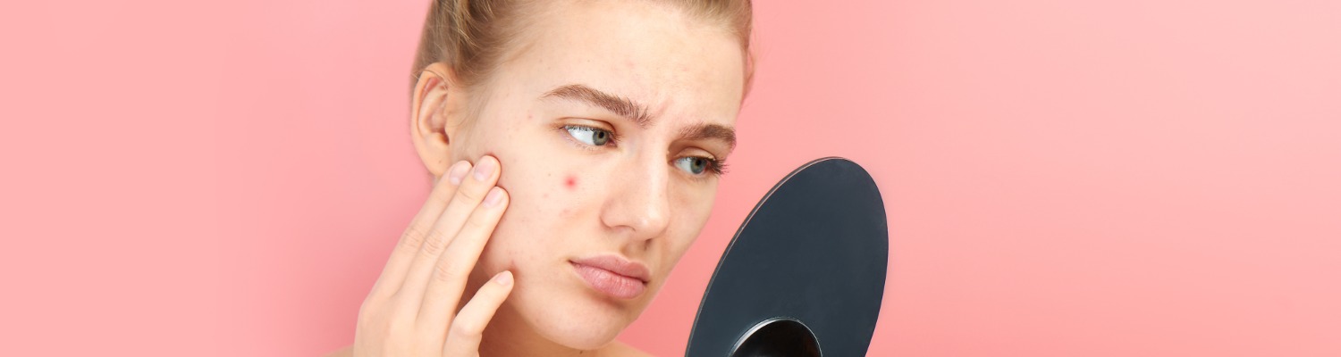 5 Acne Myths Debunked