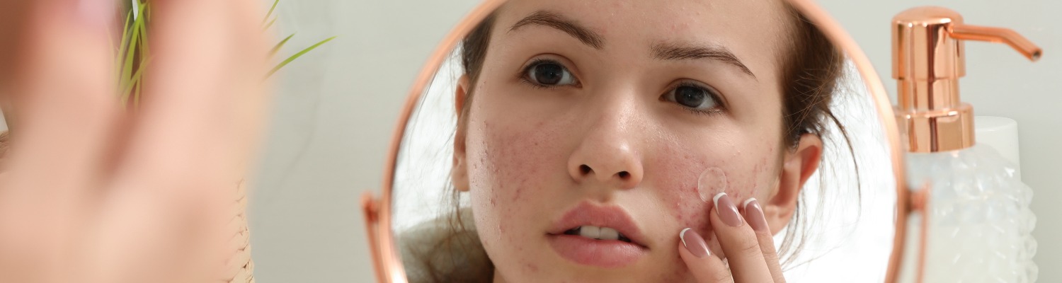 Self Esteem and Acne: How to Stay Confident