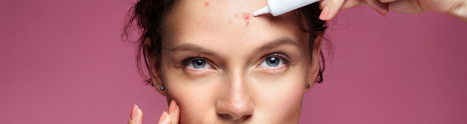 Acne Scarring: Causes, Types, Treatments, and Prevention