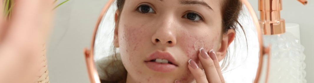Can Dermapen Micro-Needling and PRP Help Acne Scars?